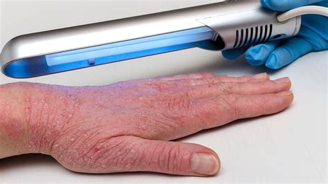 The Divine treatment UV light device: everything you need to know